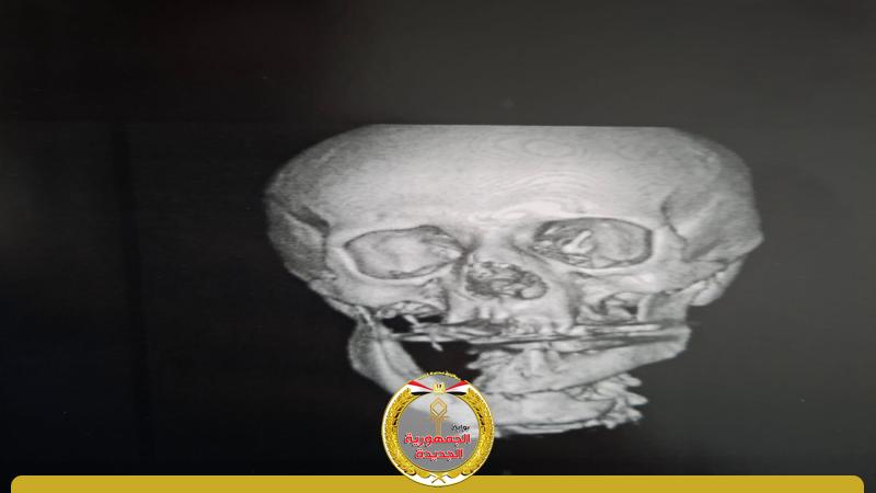 تهتك بعظام الوجه 